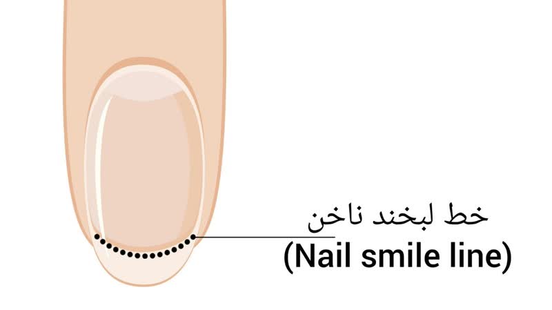 خط لبخند ناخن (Nail smile line)