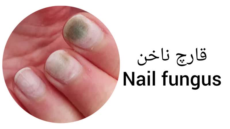 قارچ ناخن (Nail fungus)