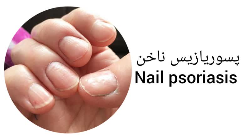 پسوریازیس ناخن (nail psoriasis)
