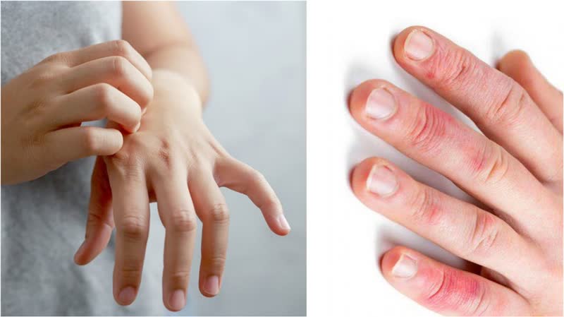 آلرژی و حساسیت دست و ناخن