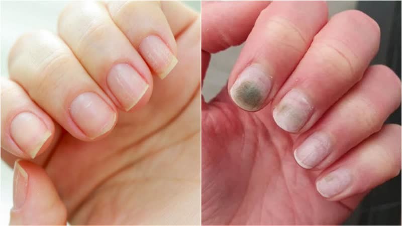 عفونت‌های قارچی و باکتریایی ناخن